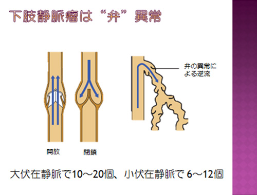 下肢静脈瘤は「弁」異常。
