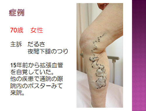 症例 70歳 女性
