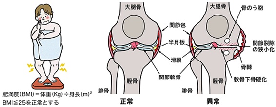 変形性膝関節症 大腿骨内顆骨壊死の治療 東京高輪病院 地域医療機能推進機構